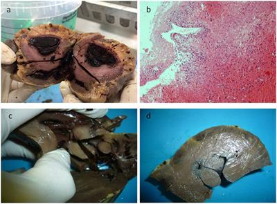 Pulmonary Eosinophilic Inflammatory Infiltration Post-Intensive Care in a Nearly Drowned Young Man with Papillary Fibroelastoma: A Rare Complication Discovered by Forensic Autopsy